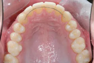 Bonded retainers