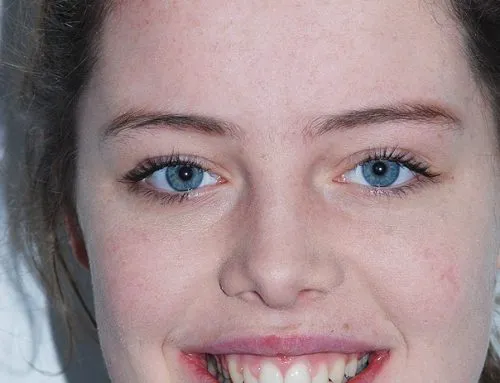 Protrusion of Teeth and Gums