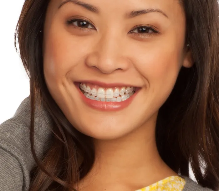 Ceramic Braces