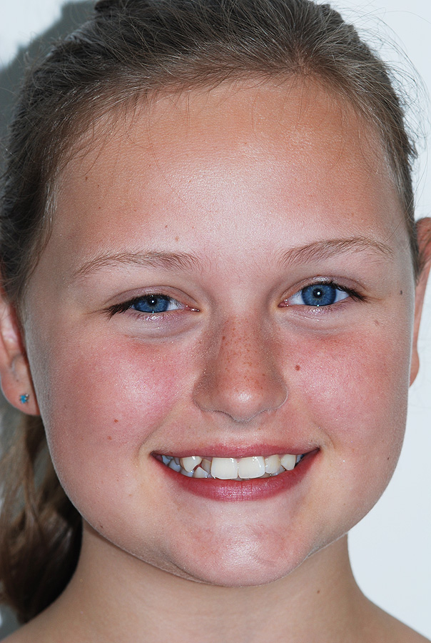 Crooked Teeth with Cross-Bite