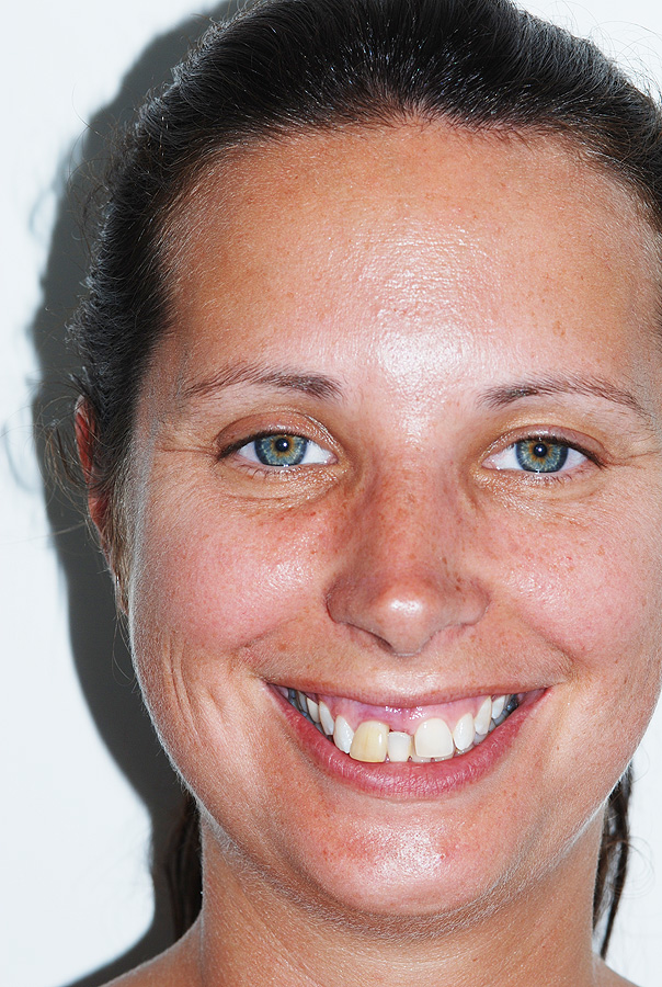 Protruding Teeth with Excess Gum Display