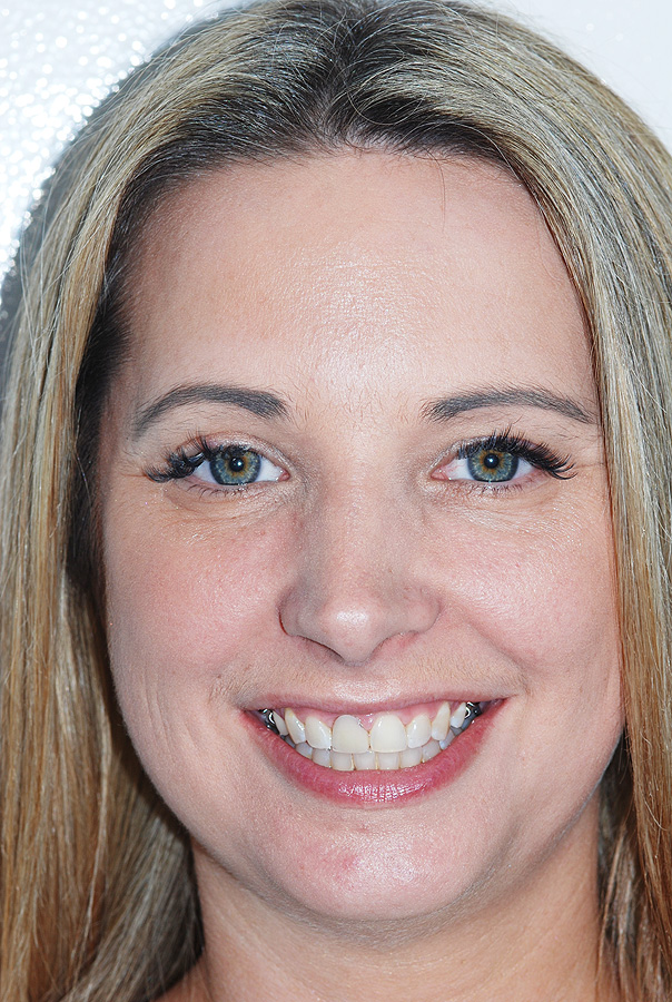 Protruding Teeth with Excess Gum Display
