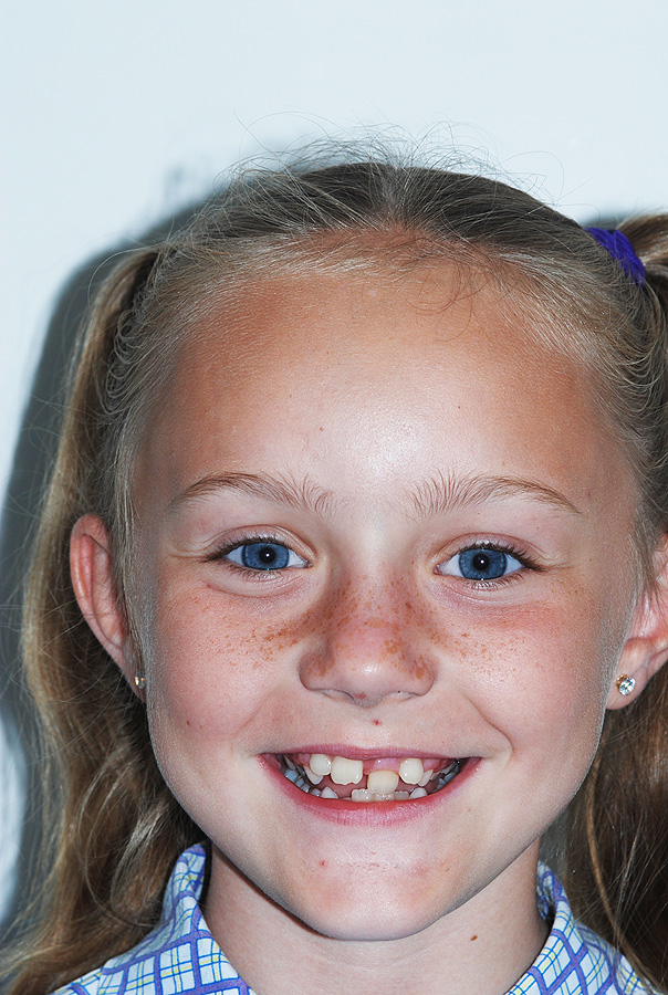Early Treatment of Child with Obstruct Front Teeth
