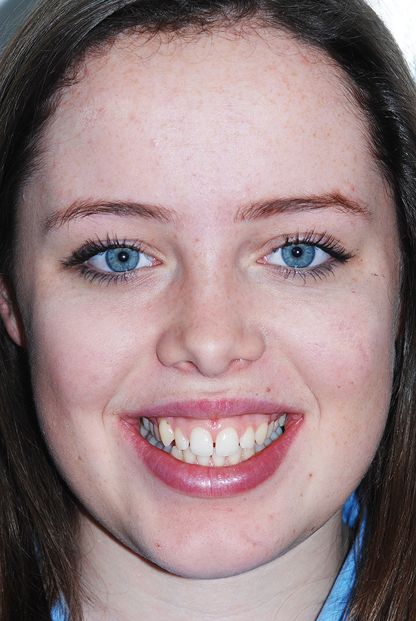 Protrusion of Teeth and Gums