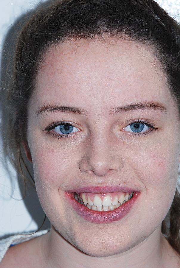 Protrusion of Teeth and Gums