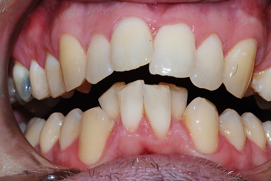 Adult Male Treatment for Crooked Teeth